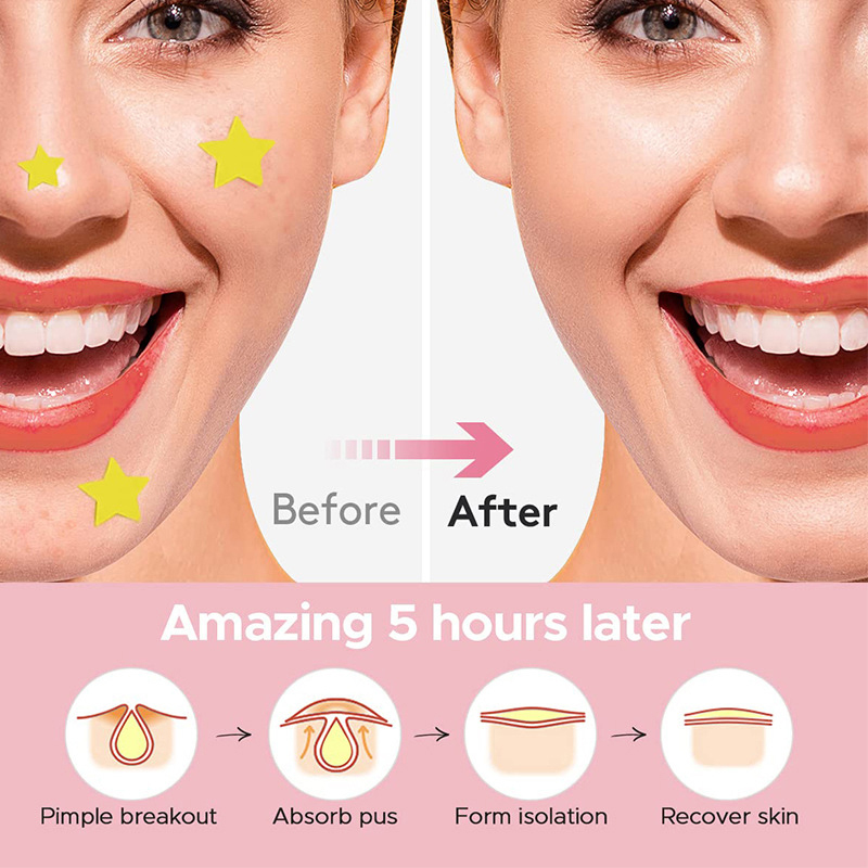 600 PCS/Set Star Pimple Patch  – Beauty Makeup Remover recenzja i cena